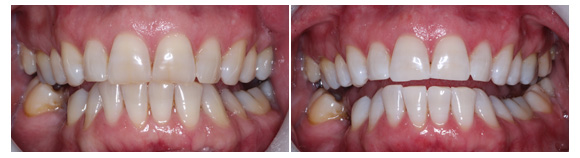 MS Dental - BA Teeth Whitening - Cardiff - Singleton - Fletcher - Newcastle