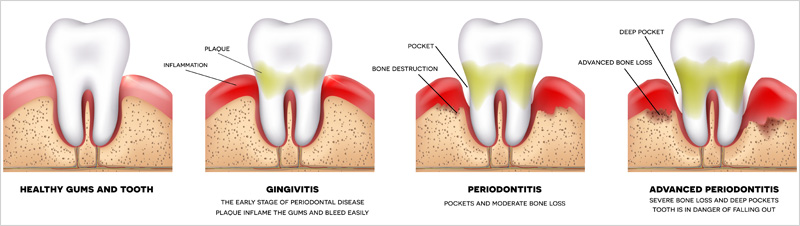 MS Dental - Symptoms of Gum Disease - Cardiff - Singleton - Fletcher - Newcastle