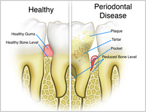 MS Dental - Periodontal disease - Cardiff - Singleton - Fletcher - Newcastle