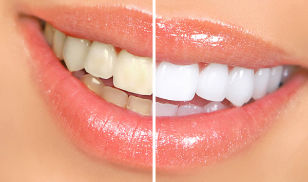 MS Dental - BA teeth whitening - Cardiff - Singleton - Fletcher - Newcastle