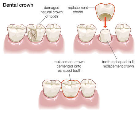 MS Dental - Care for Temporary Dental Crown - Cardiff - Singleton - Fletcher - Newcastle