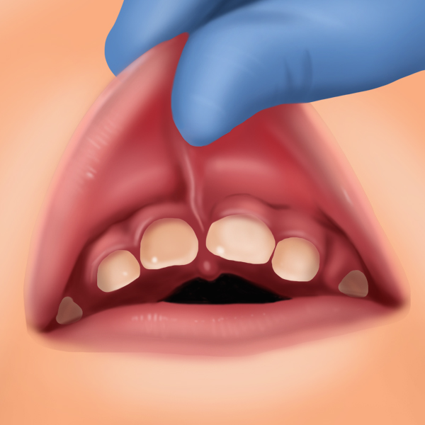 Laser Tongue And Lip Tie Treatment Newcastle Cardiff Singleton