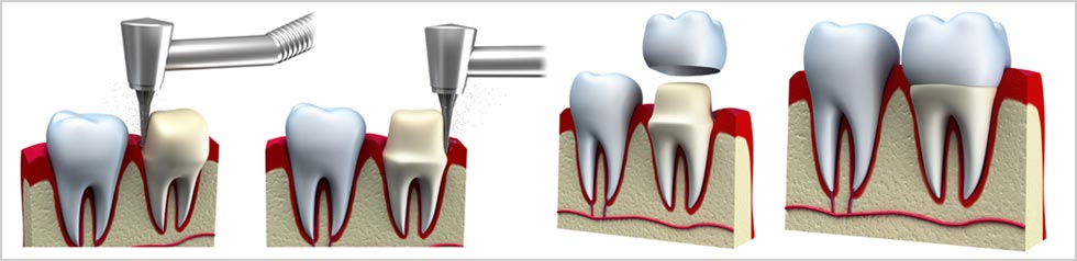 MS Dental - Tooth Crown Process - Cardiff - Singleton - Fletcher - Newcastle