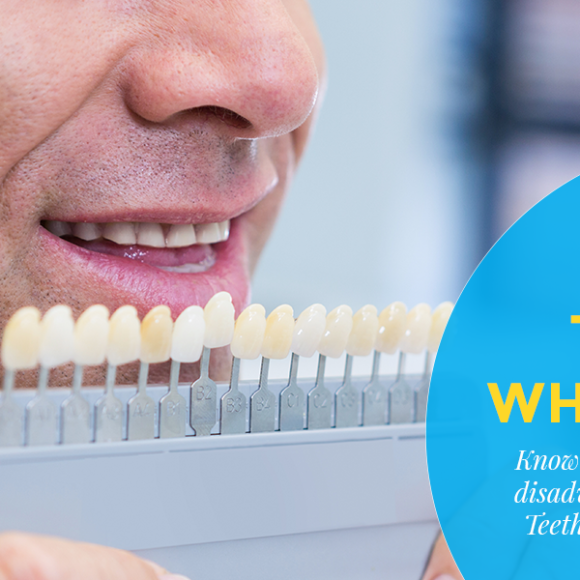 Teeth Whitening – Which is the best option for you?