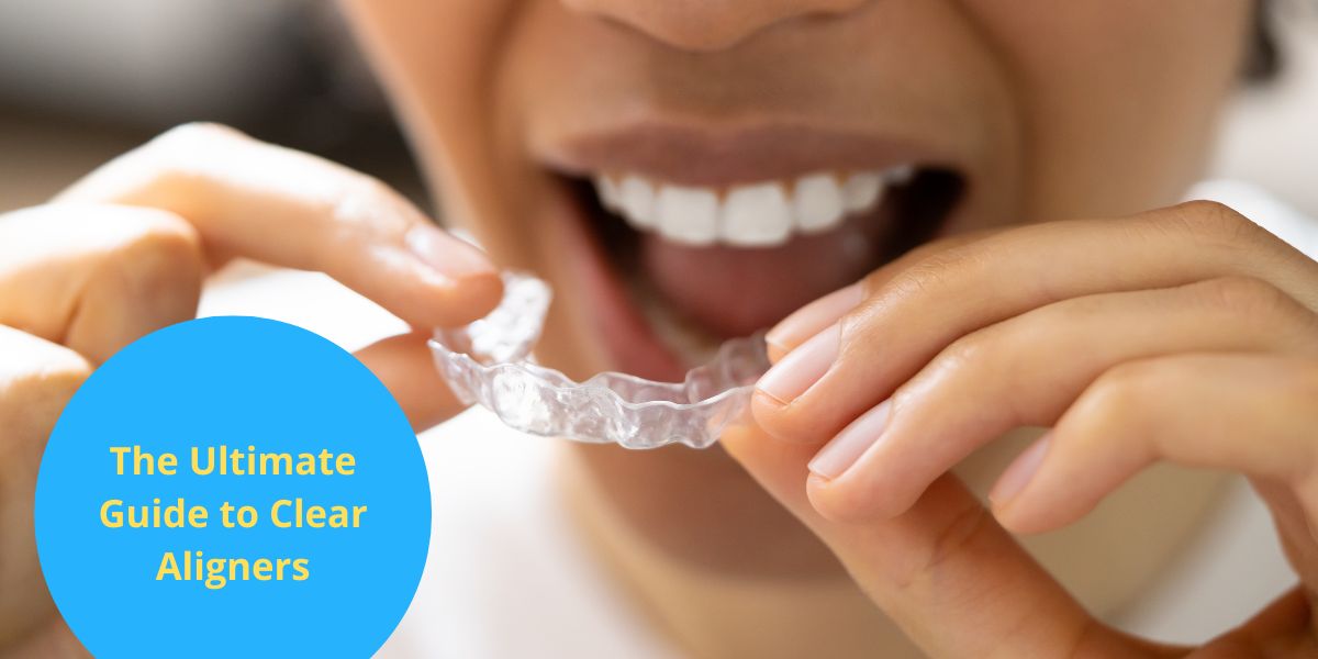 The Ultimate Guide to Clear Aligners: Everything You Need to Know